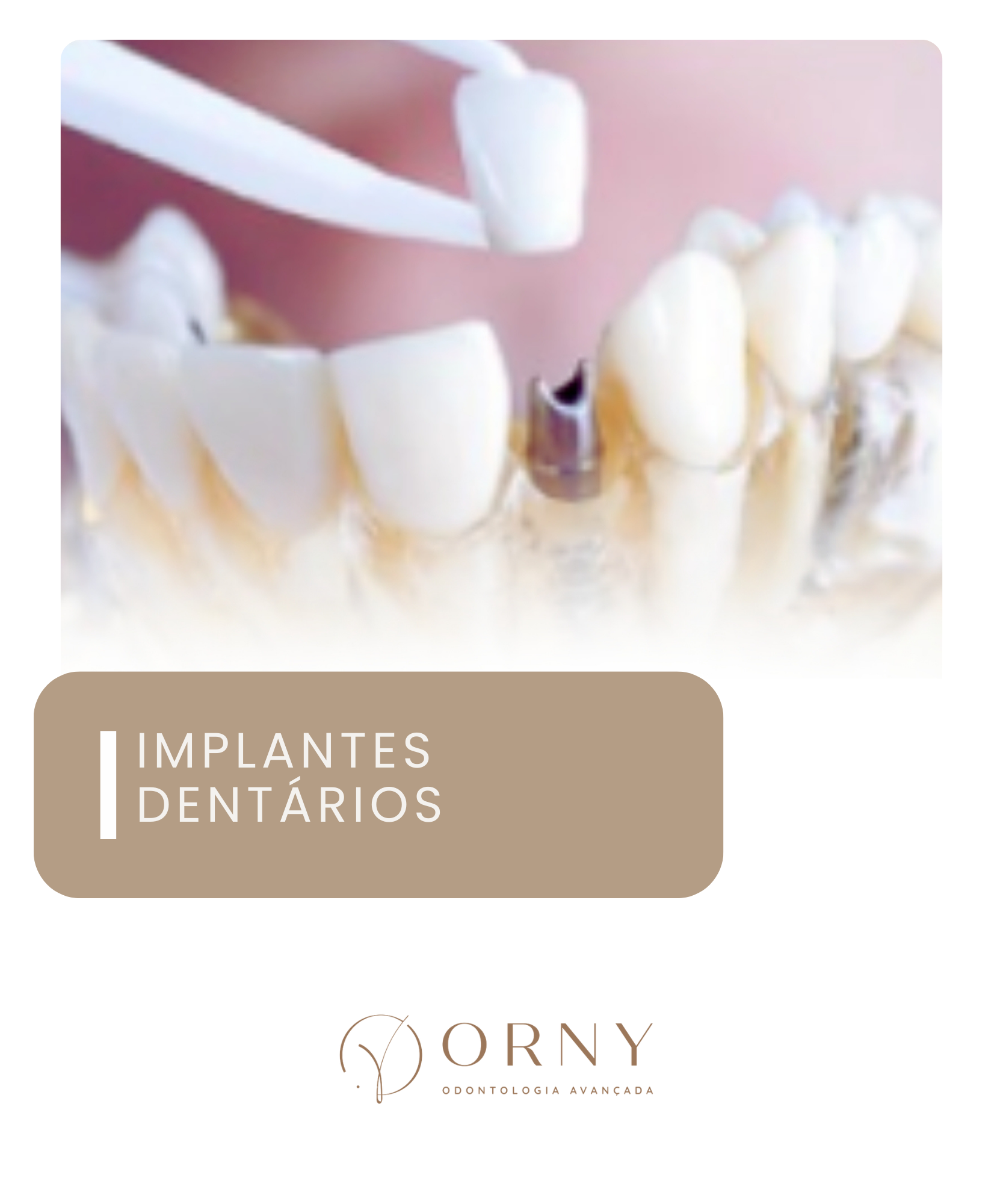 IMPLANTE DENTARIO ORNY ODONTOLOGIA CAMPINAS