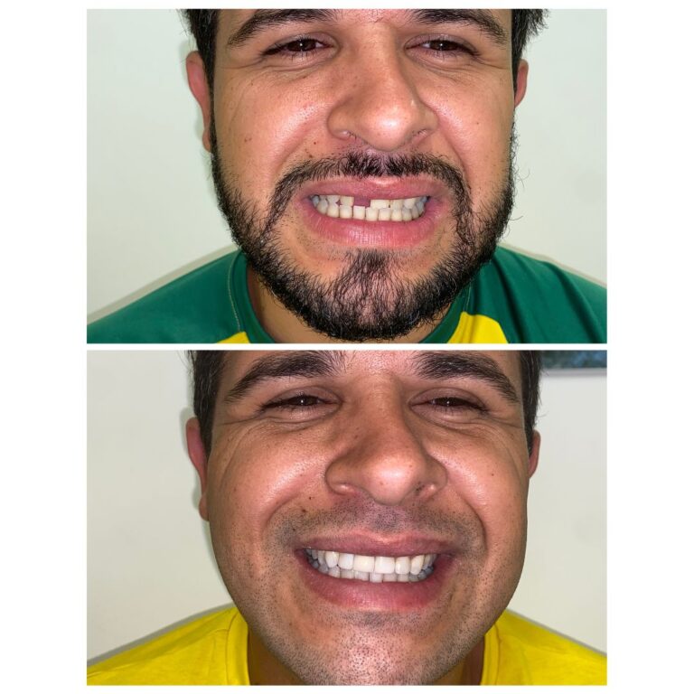 implante-dentario-campinas-antes-depois.jpg