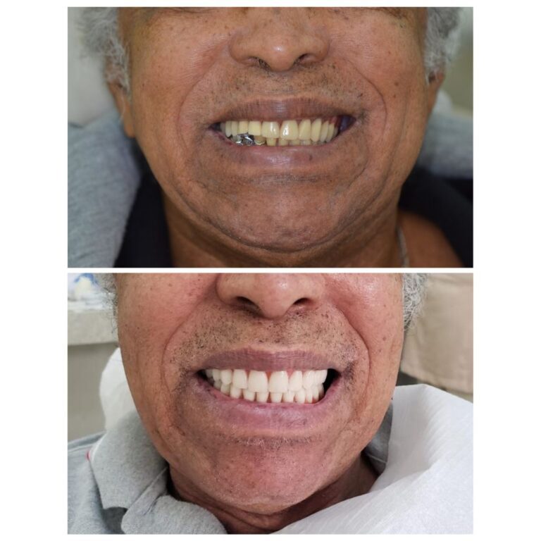 implante-dentario-campinas-antes-depois.jpg