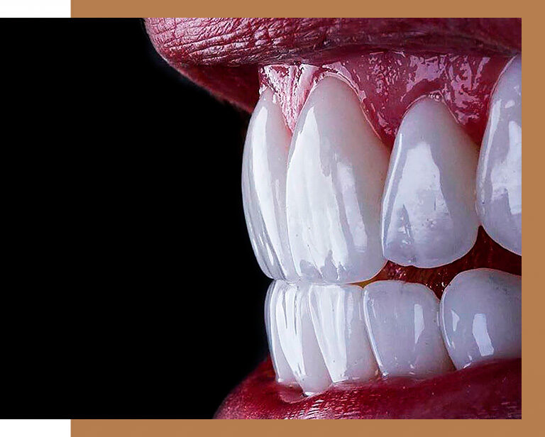 faceta dental em campinas na orny odontologia