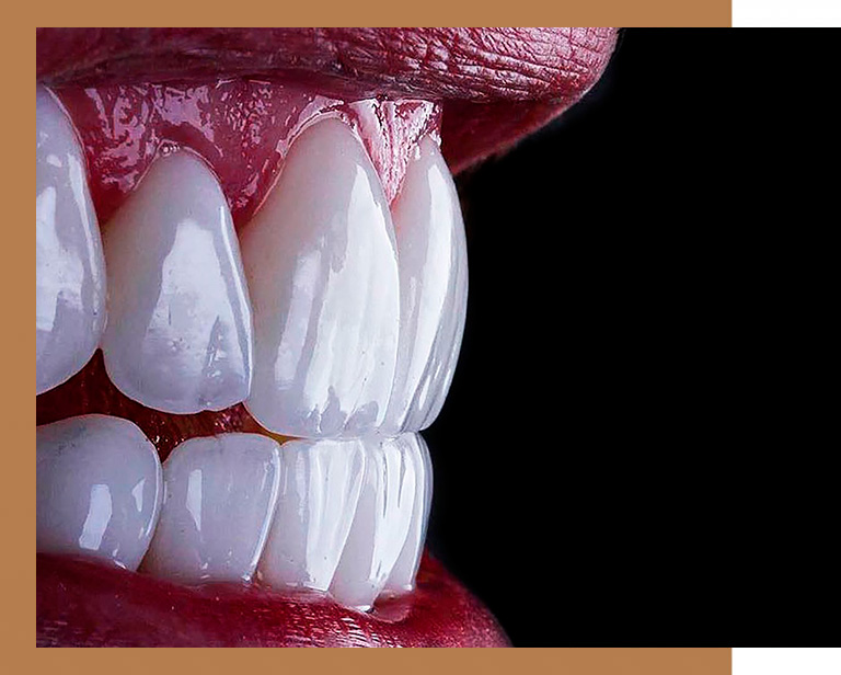 faceta dental em campinas na orny odontologia