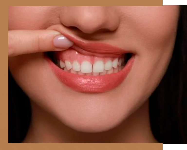 gengivoplastia em camppinas orny odontologia