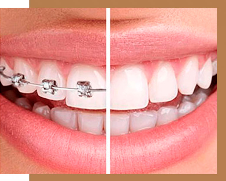 aparelhos ortodonticos campinas.Transforme seu sorriso com Ortodontia em Campinas! Na Orny Odontologia, você encontra aparelhos modernos como Invisalign®, autoligados e convencionais. Agende sua avaliação e conquiste o sorriso dos seus sonhos! Invisalign Campinas: Alinhe Seu Sorriso com Discrição na Orny Odontologia